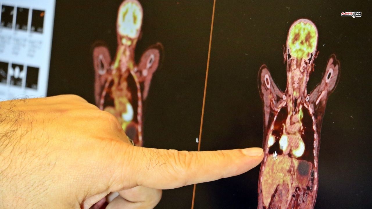 Kanser Oran Ajnas344 (1)