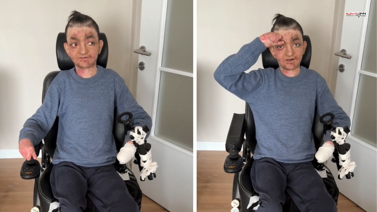 Kahramanmaraş’ta Kelebek Hastası Gençten Yardım Çağrısı