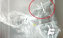 İmplant tedavisinde vida beynine saplandı