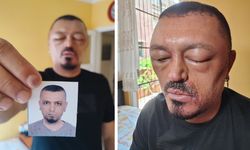 Saç Şampuanı Alerjiye Yol Açtı: Yüzü ve Gözleri Şişti