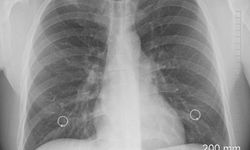 Akciğer Kanseri Gerçeği: Her Yıl Milyonlar Hayatını Kaybediyor!