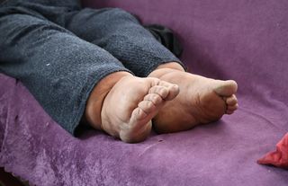 Bacakları 80 santimetre çapına ulaştı, hastalığın tedavisi yok