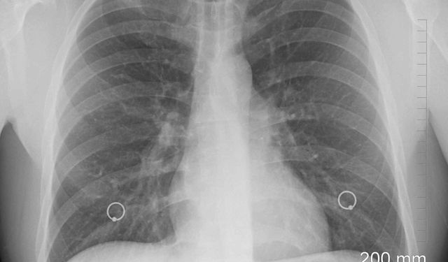 Akciğer Kanseri Gerçeği: Her Yıl Milyonlar Hayatını Kaybediyor!